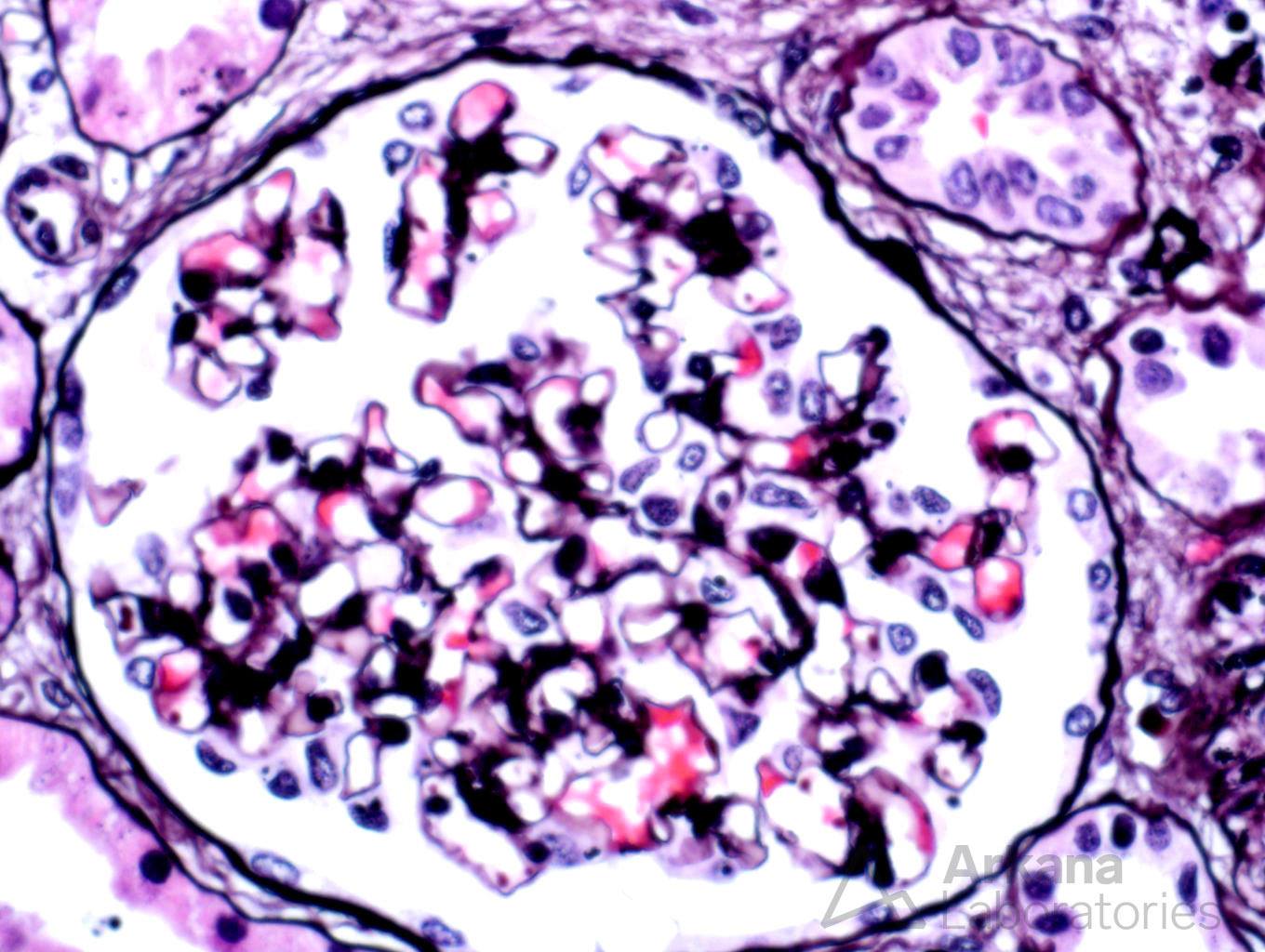 light chain deposition disease