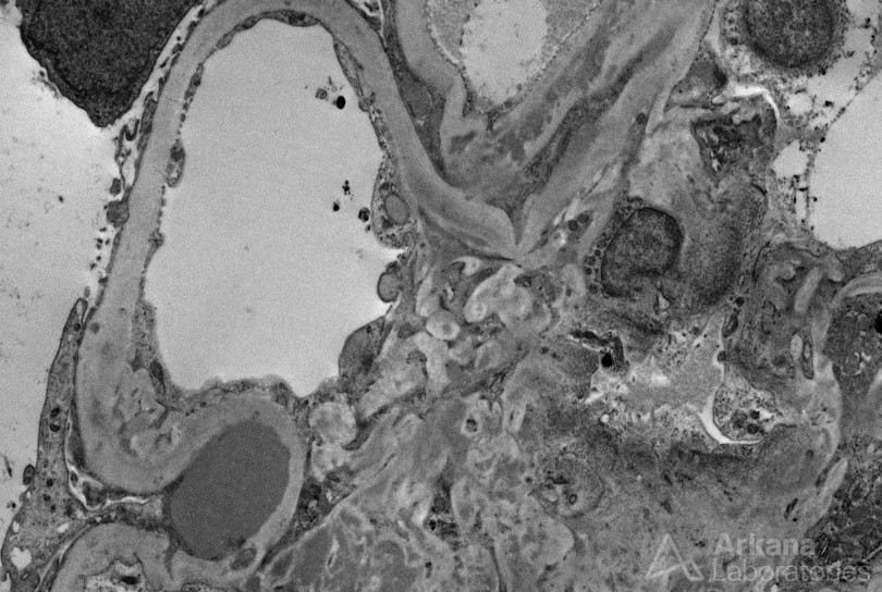 Infection-Associated Glomerulonephritis, EM Imaging