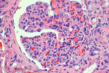 Cryoglobulinemic Glomerulonephritis