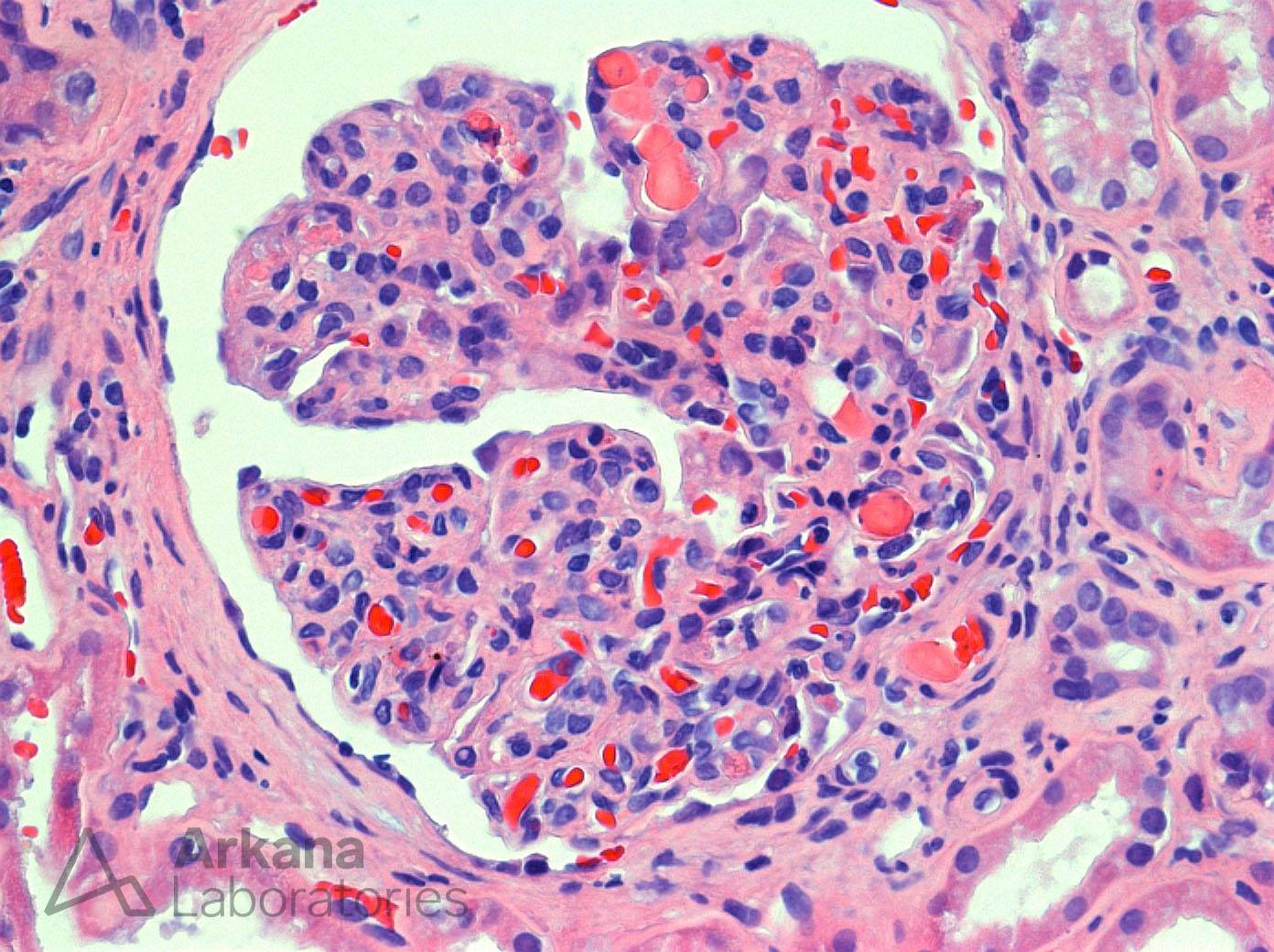 Cryoglobulinemic Glomerulonephritis