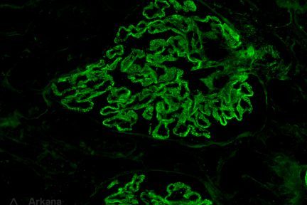 Membranous Glomerulopathy