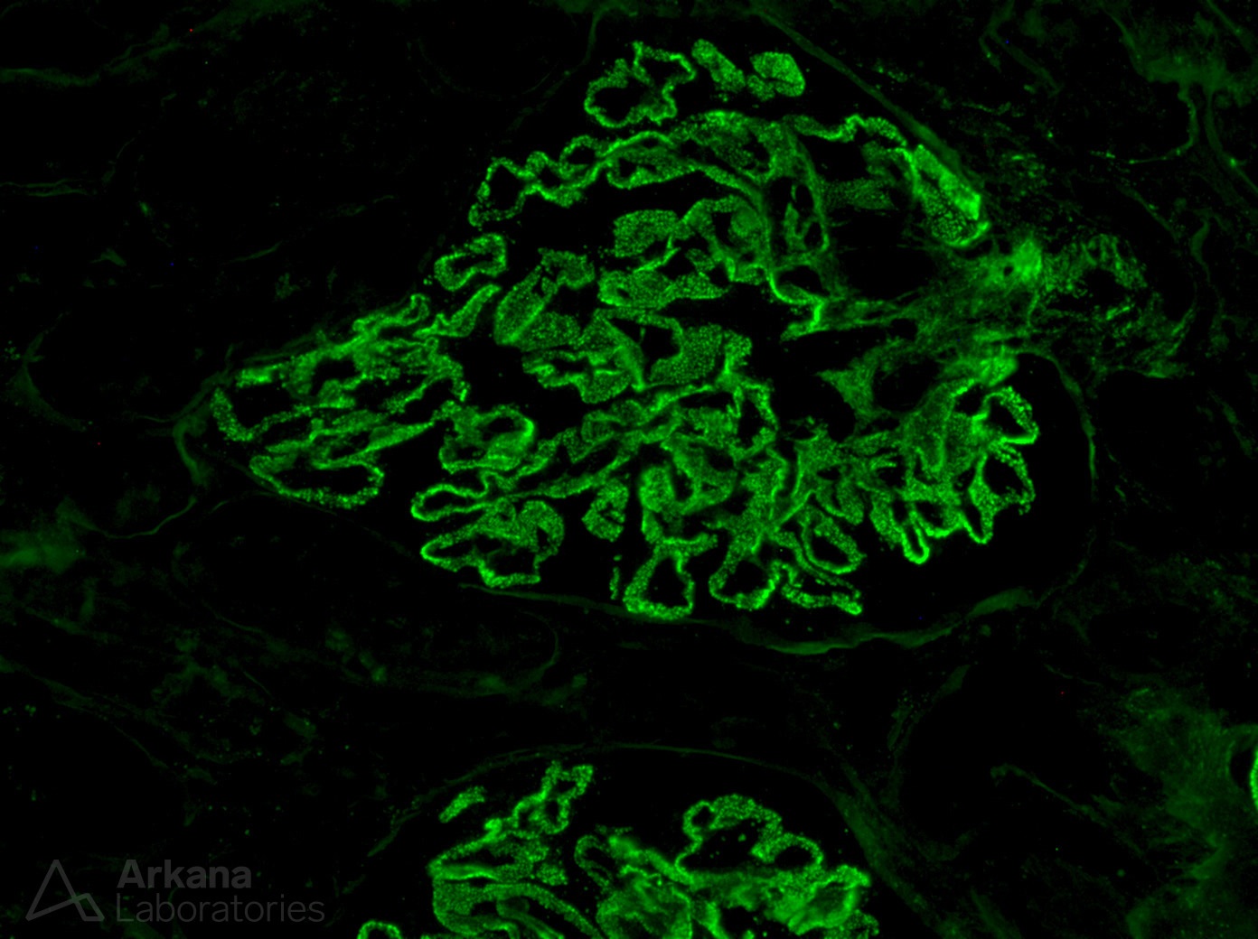 Membranous Glomerulopathy