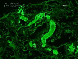 positive Kappa stain for Light Chain Cast Nephropathy