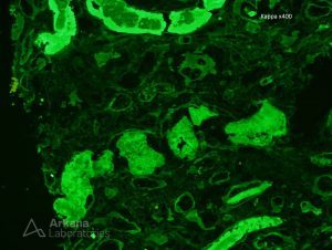 Positive Kappa IF stain showing Light Chain Cast Nephropathy