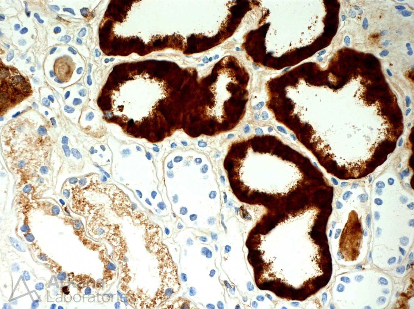 Lysozyme Nephropathy imaging diagnosis