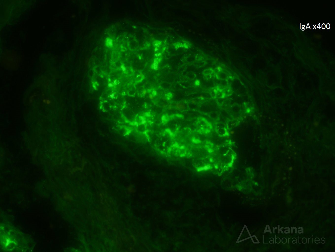 cryoglobulinemia