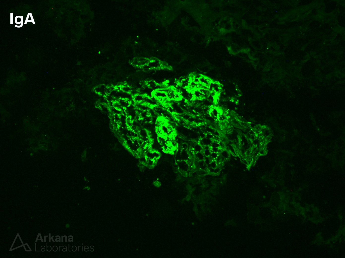 IgA Dominant Infection-Associated Glomerulonephritis