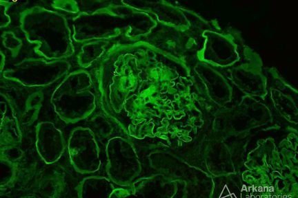 IgG Background Staining in Diabetic Nephropathy