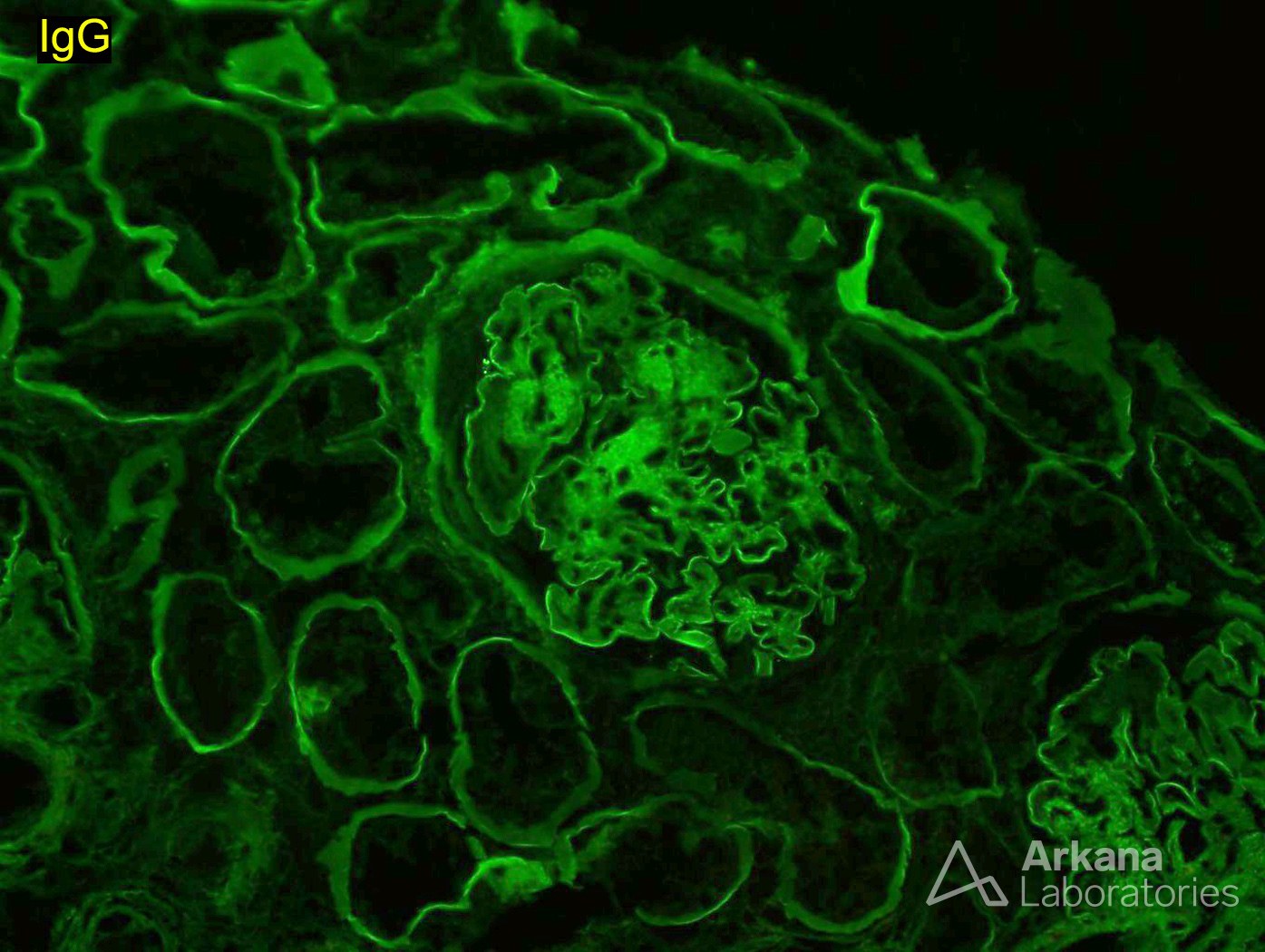 IgG Background Staining in Diabetic Nephropathy