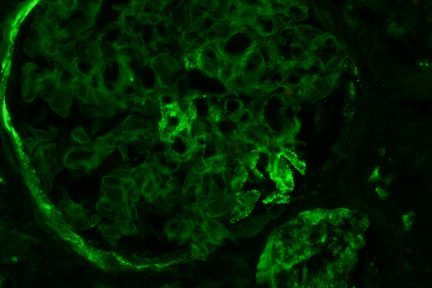 Anti-Brush Border Antibody Tubulointerstitial Nephritis