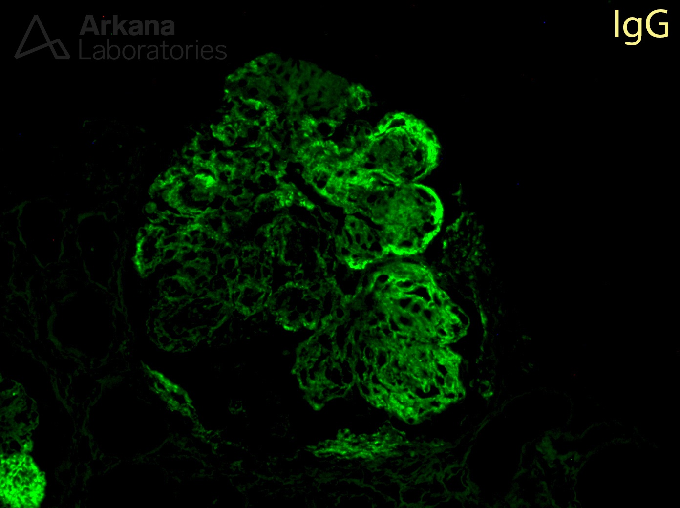 monoclonal gammopathy of renal significance