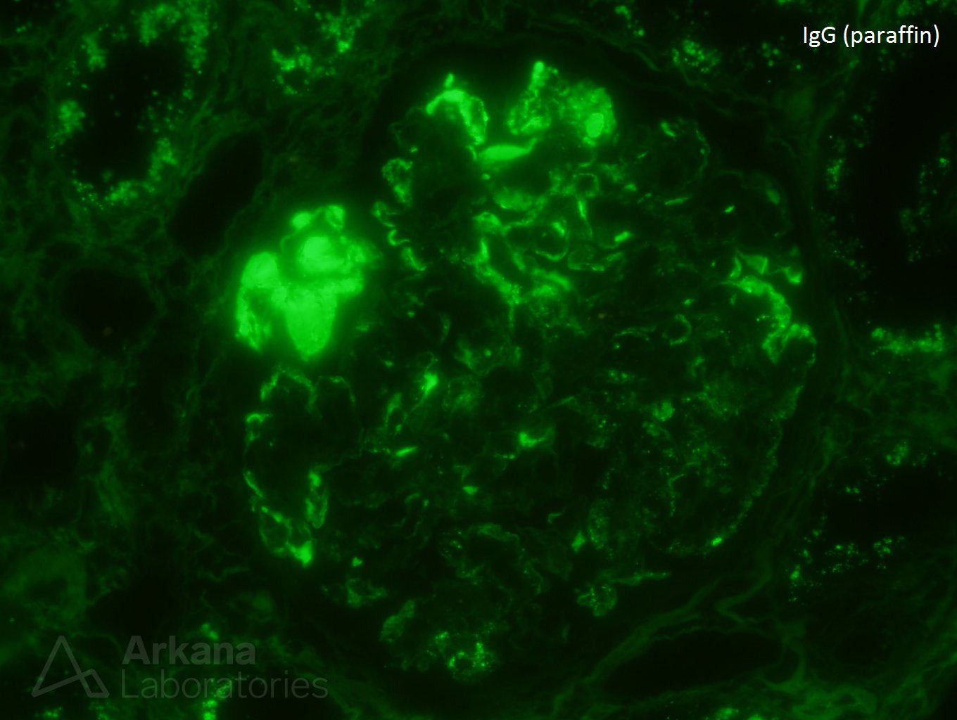 type I cryoglobulinemia