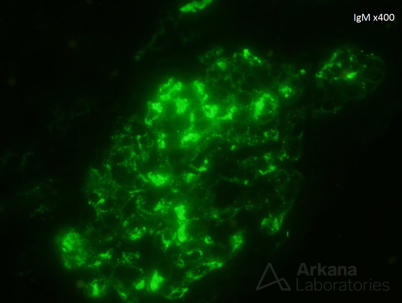 cryoglobulinemia