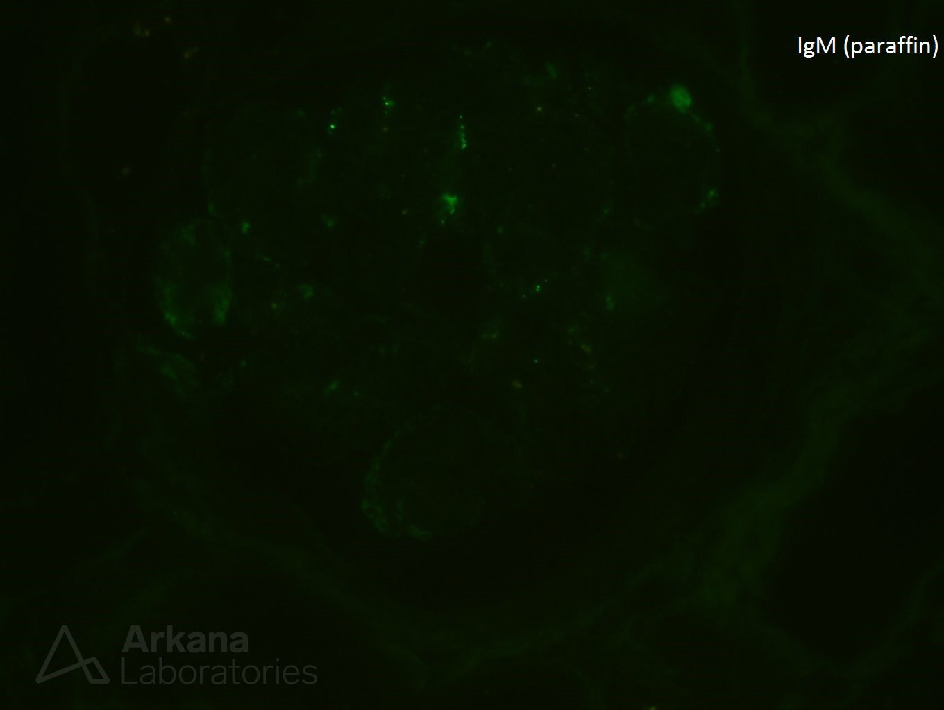 type I cryoglobulinemia