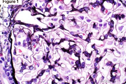 Membranous Lupus Nephritis, arkana laboratories, renal pathology, kidney biopsy