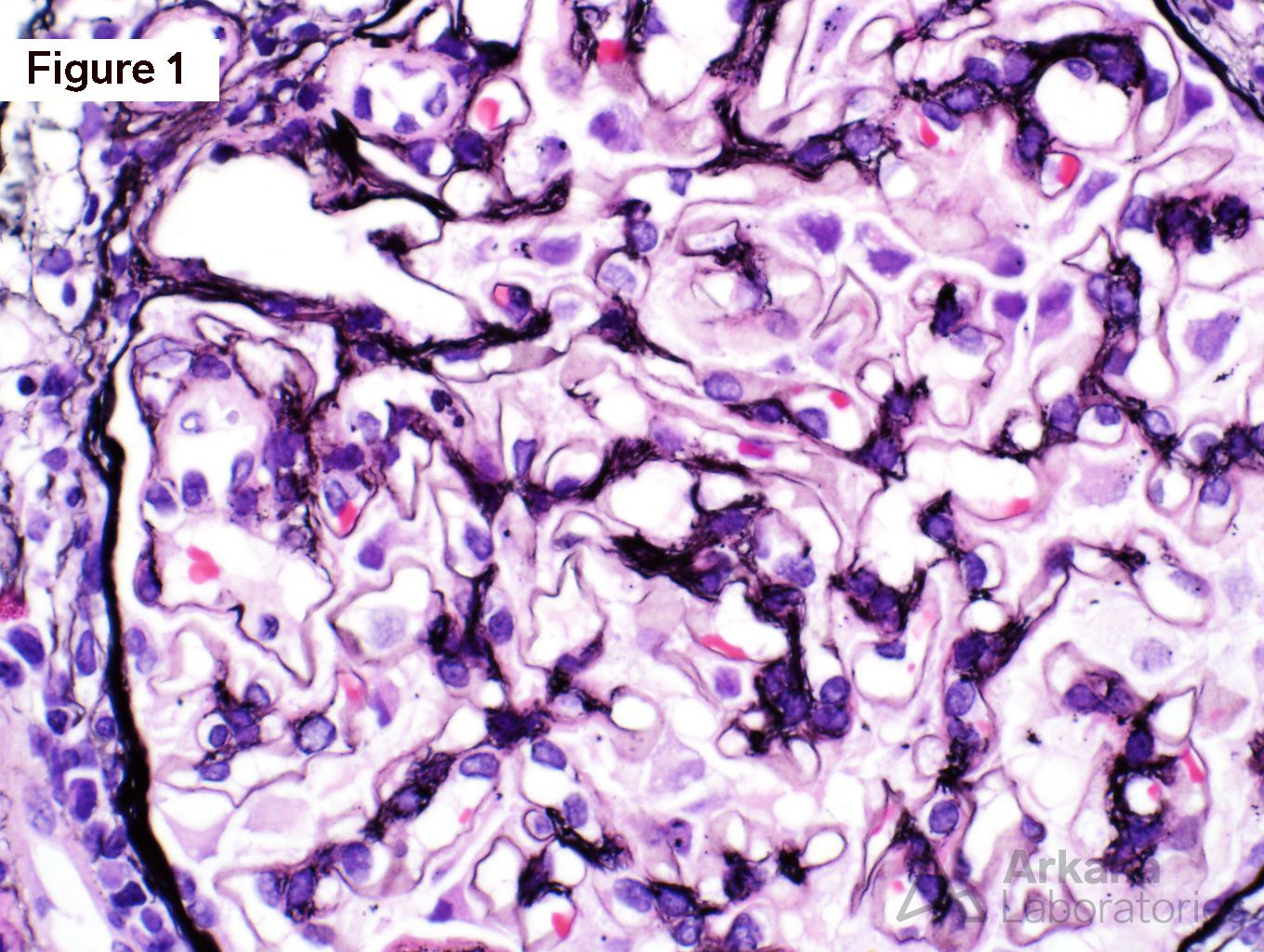 Membranous Lupus Nephritis, arkana laboratories, renal pathology, kidney biopsy