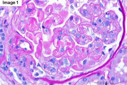 Type 1 Cryoglobulinemic Glomerulonephritis, arkana laboratories