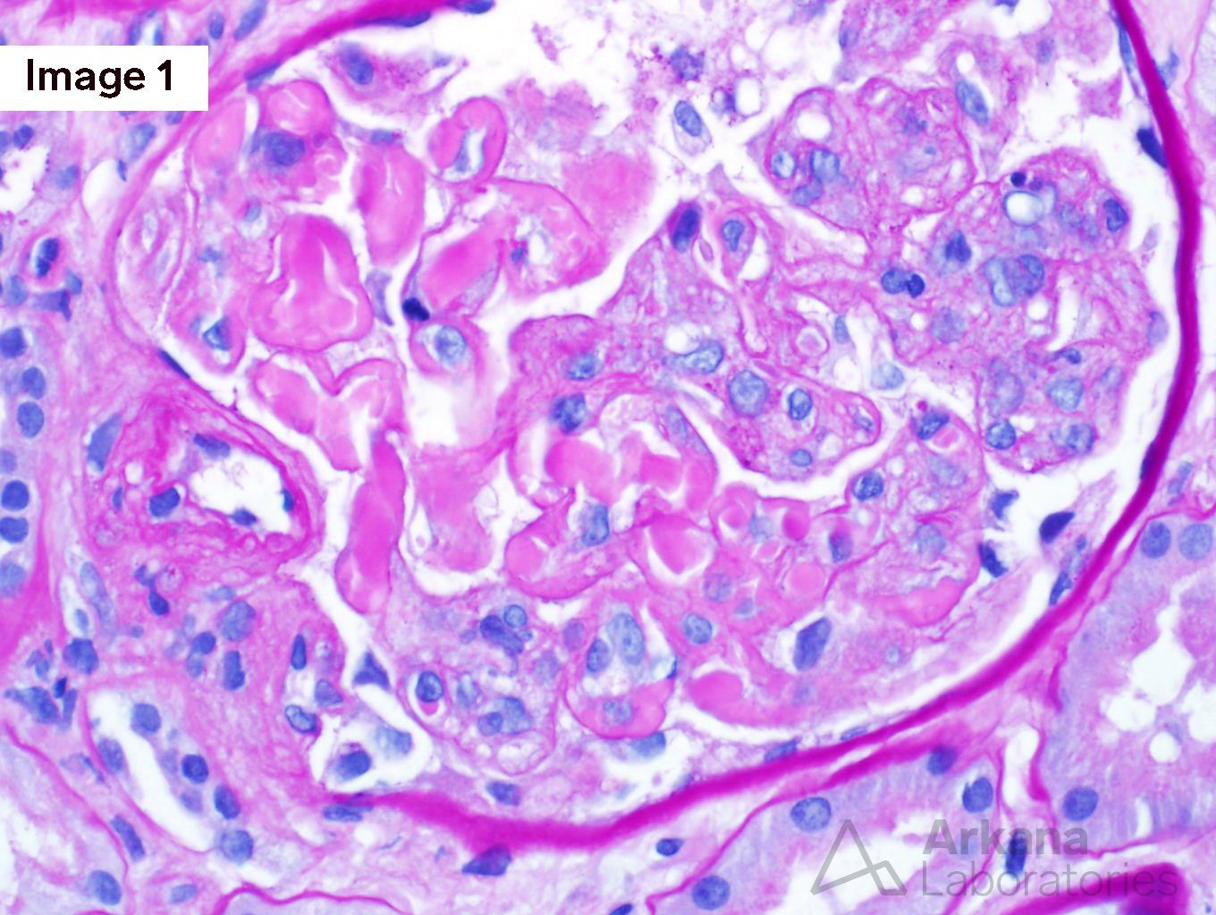 Type 1 Cryoglobulinemic Glomerulonephritis, arkana laboratories