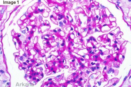 Methotrexate-induced acute kidney injury, Methotrexate-Induced Crystal Nephropathy, teaching points, Arkana Laboratories