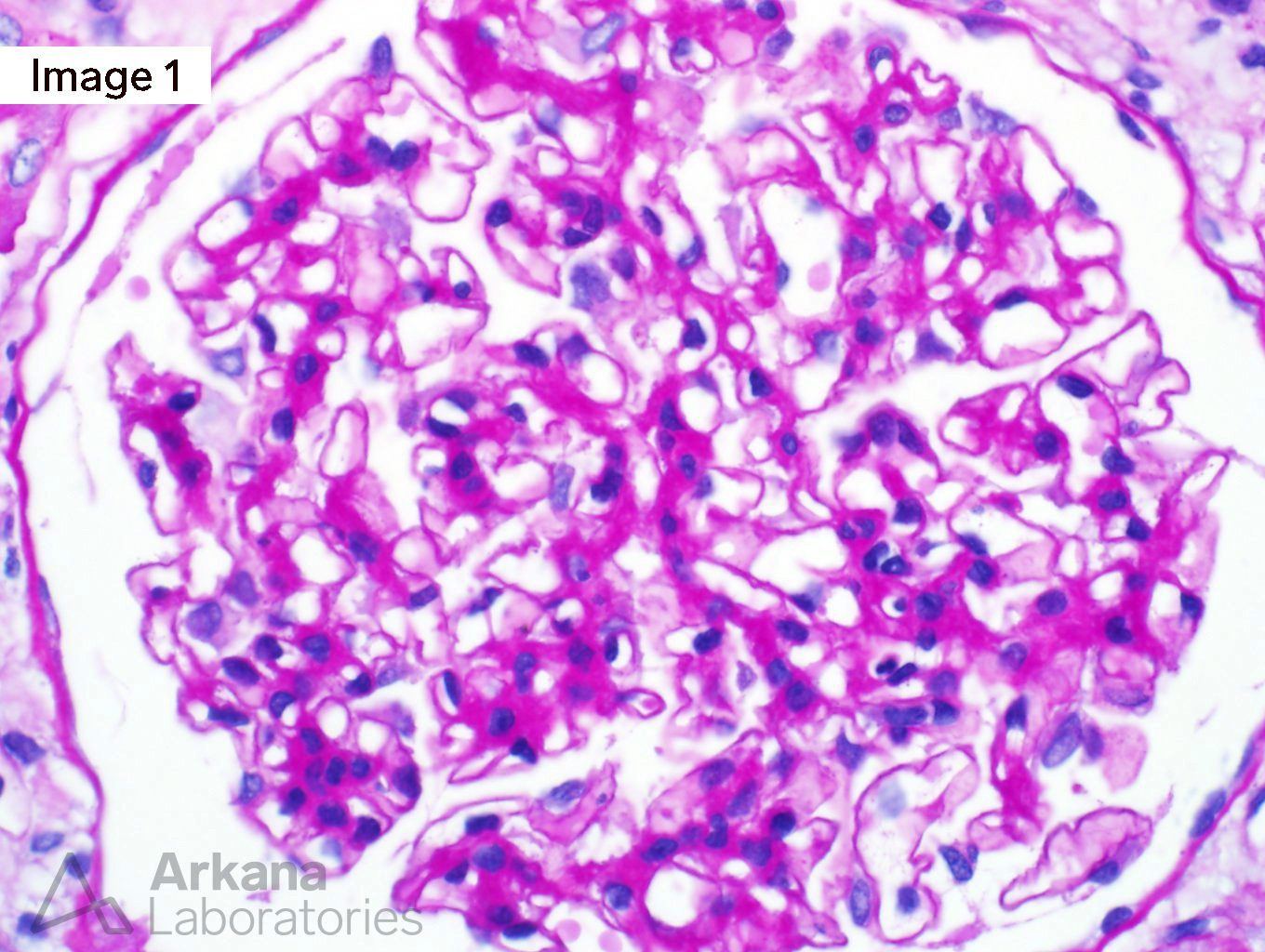 Methotrexate-induced acute kidney injury, Methotrexate-Induced Crystal Nephropathy, teaching points, Arkana Laboratories