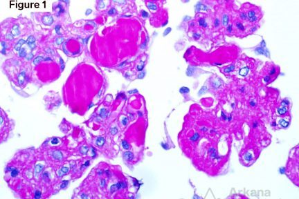 Waldenström's Macroglobulinemia, arkana laboratories, teaching points for renal pathology, kidney biopsy