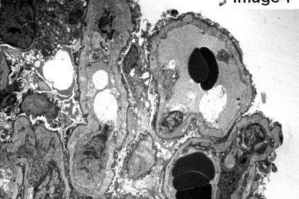 Arkana Laboratories, renal pathology, Membranous Nephropathy