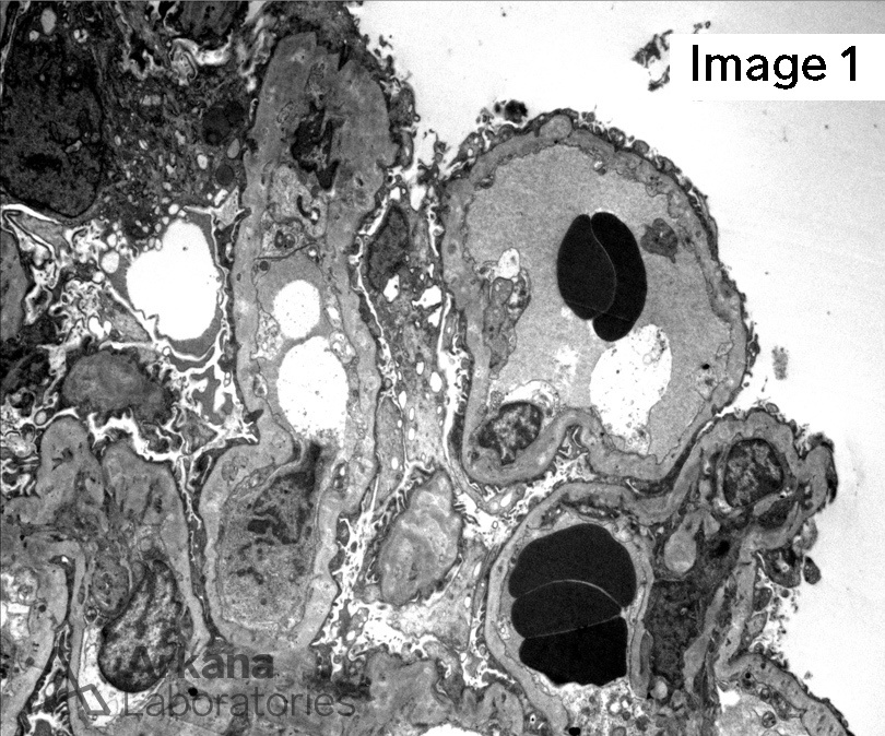 Arkana Laboratories, renal pathology, Membranous Nephropathy