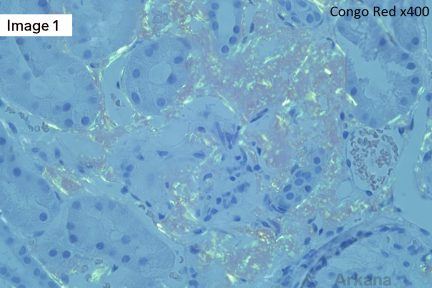 ALECT2 Amyloidosis, arkana laboratories, renal pathology