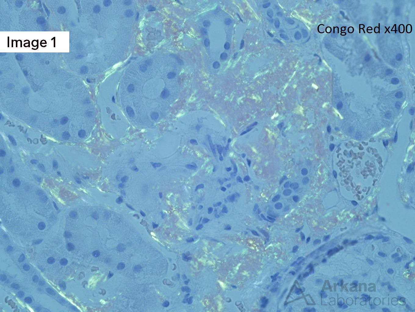 ALECT2 Amyloidosis, arkana laboratories, renal pathology