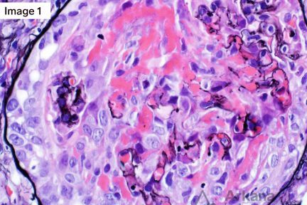 Endocarditis-Associated Glomerulonephritis, arkana laboratories, renal pathology teaching points