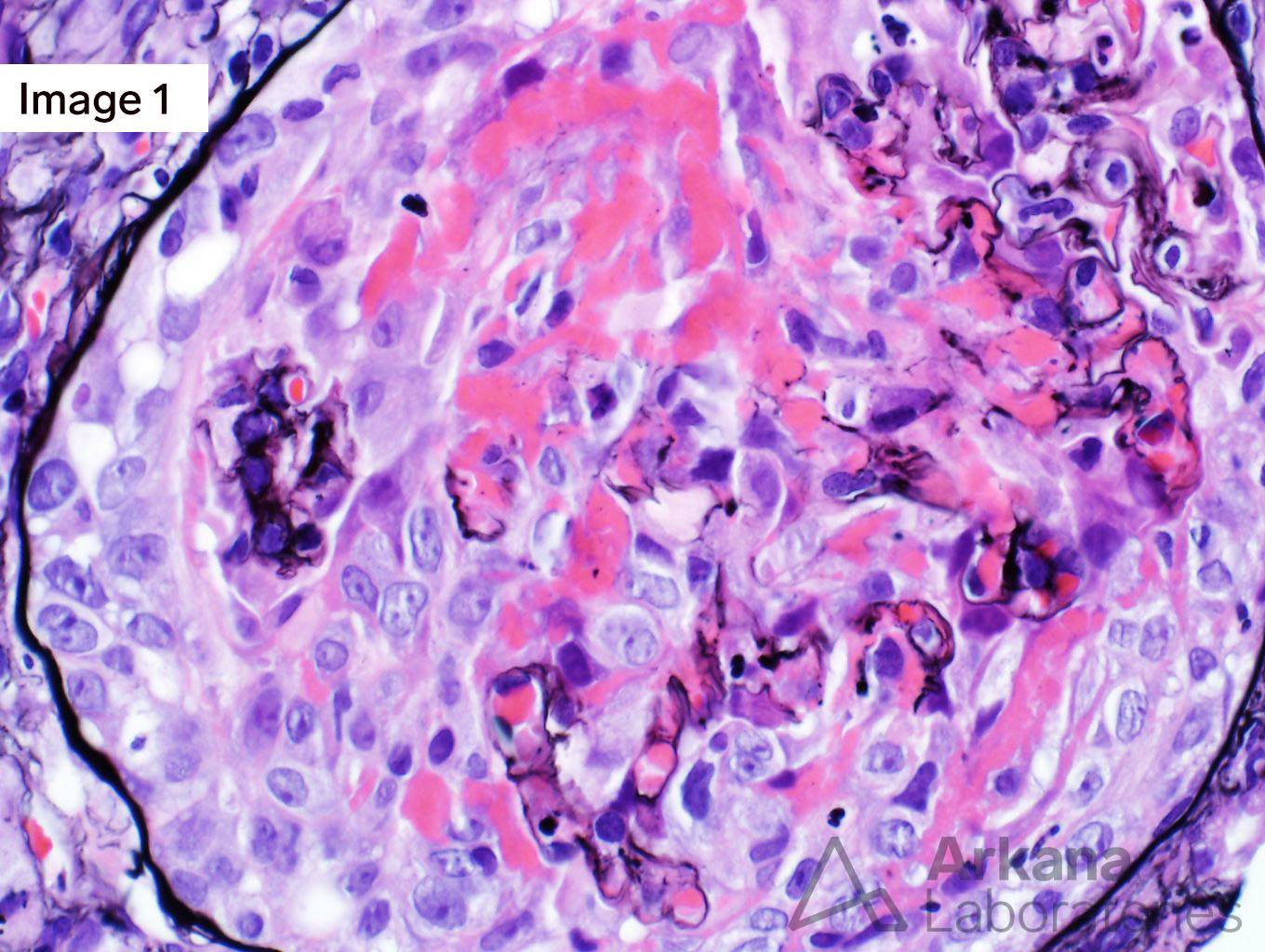 Endocarditis-Associated Glomerulonephritis, arkana laboratories, renal pathology teaching points