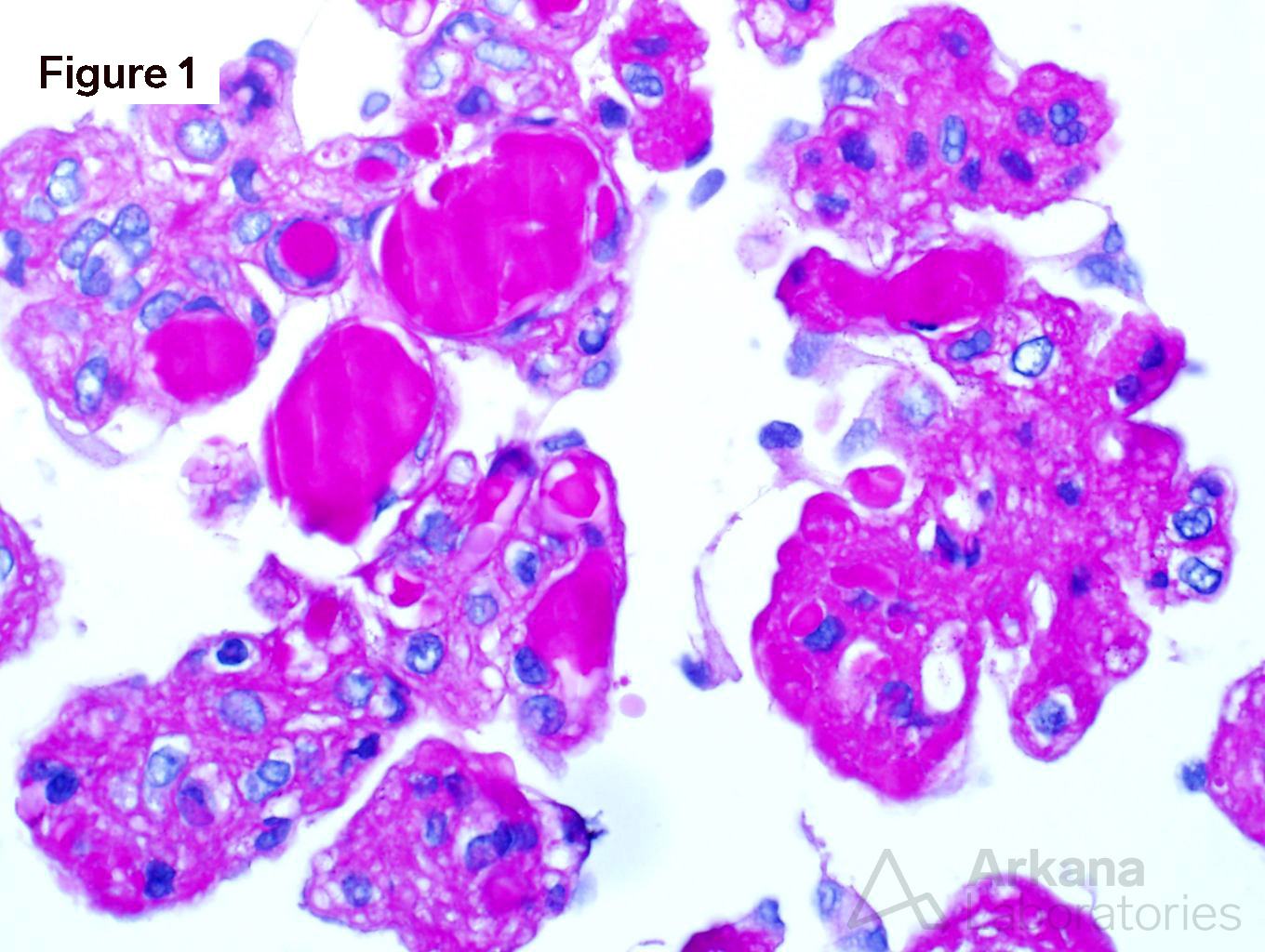 Waldenström's Macroglobulinemia, arkana laboratories, teaching points for renal pathology, kidney biopsy