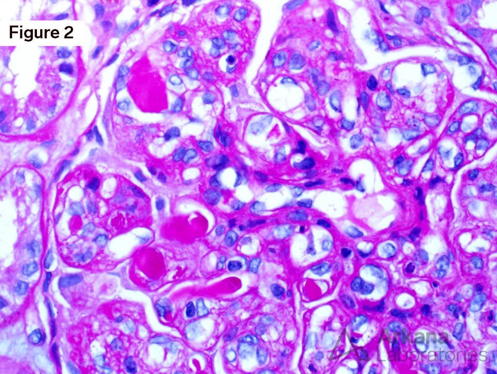 Waldenström's Macroglobulinemia, renal pathology for kidney disease