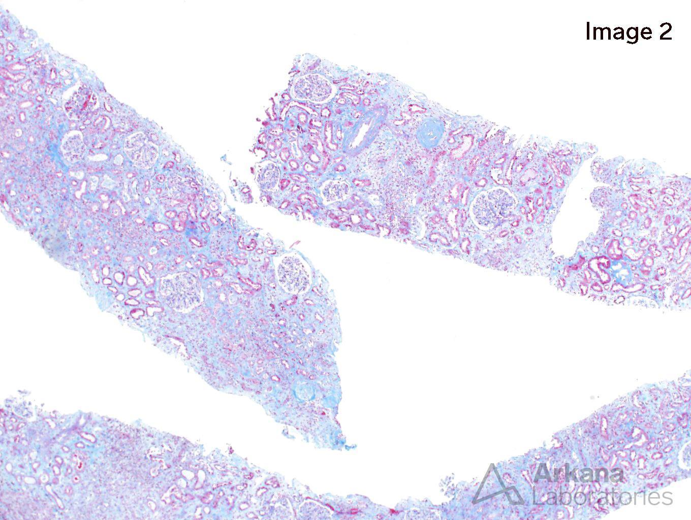 Methotrexate-Induced Crystal Nephropathy