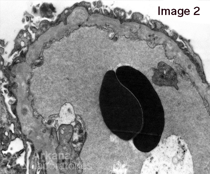 Membranous Nephropathy