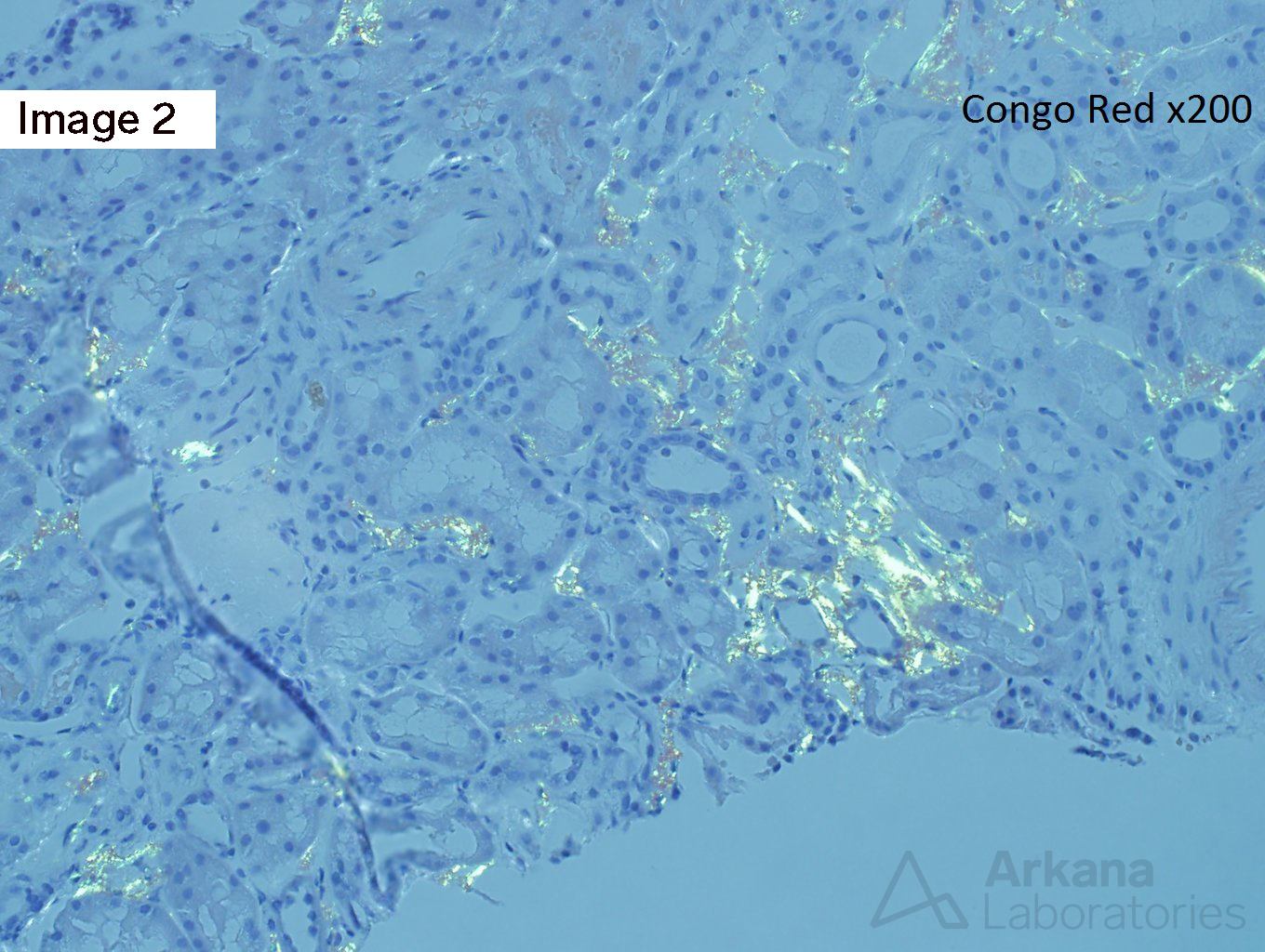 ALECT2 Amyloidosis