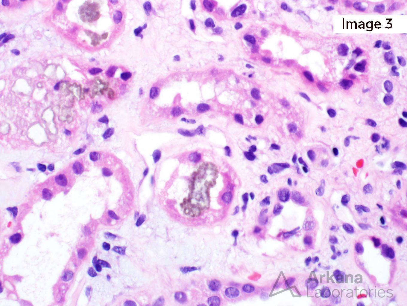 Methotrexate-Induced Crystal Nephropathy