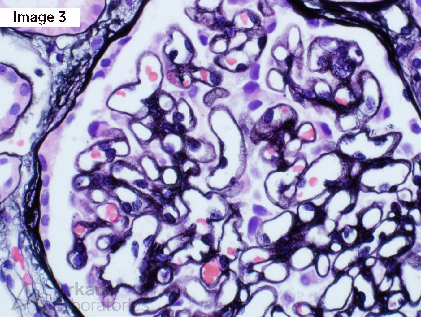 Membranous Nephropathy