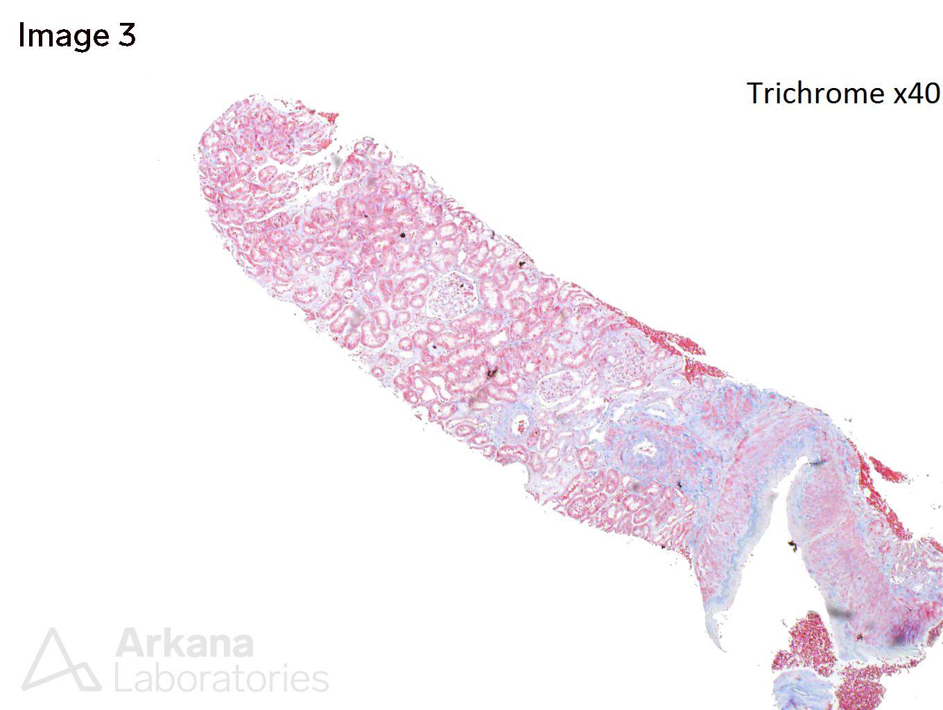 ALECT2 Amyloidosis