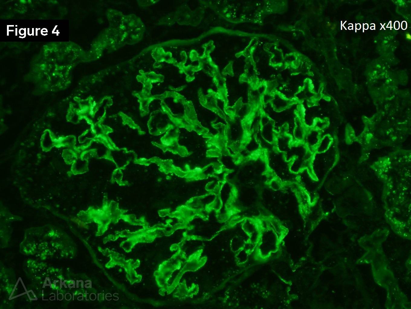 Membranous Lupus Nephritis