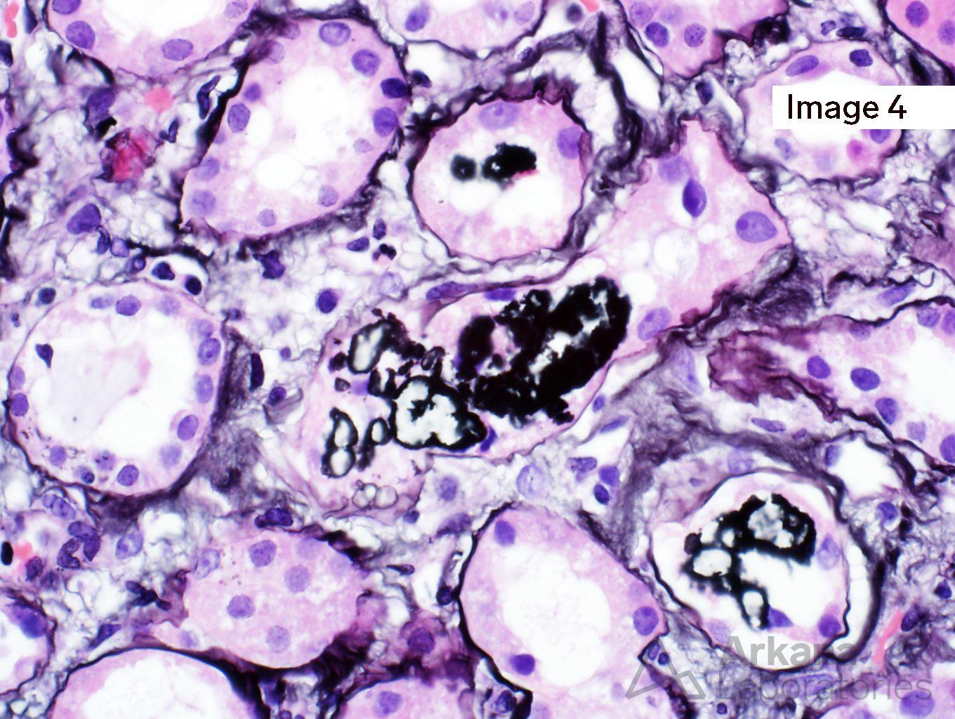 Methotrexate-Induced Crystal Nephropathy