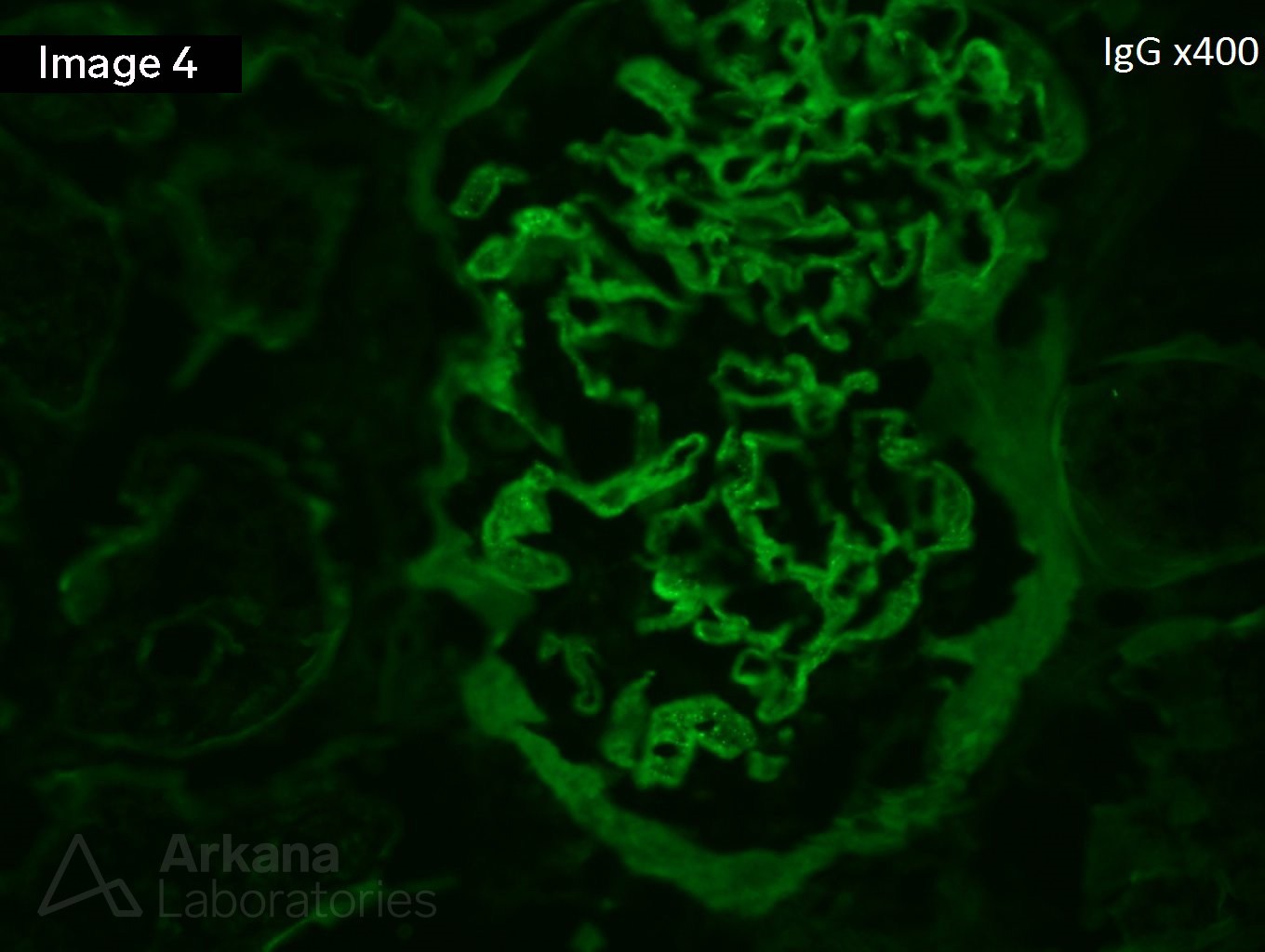 Membranous Nephropathy