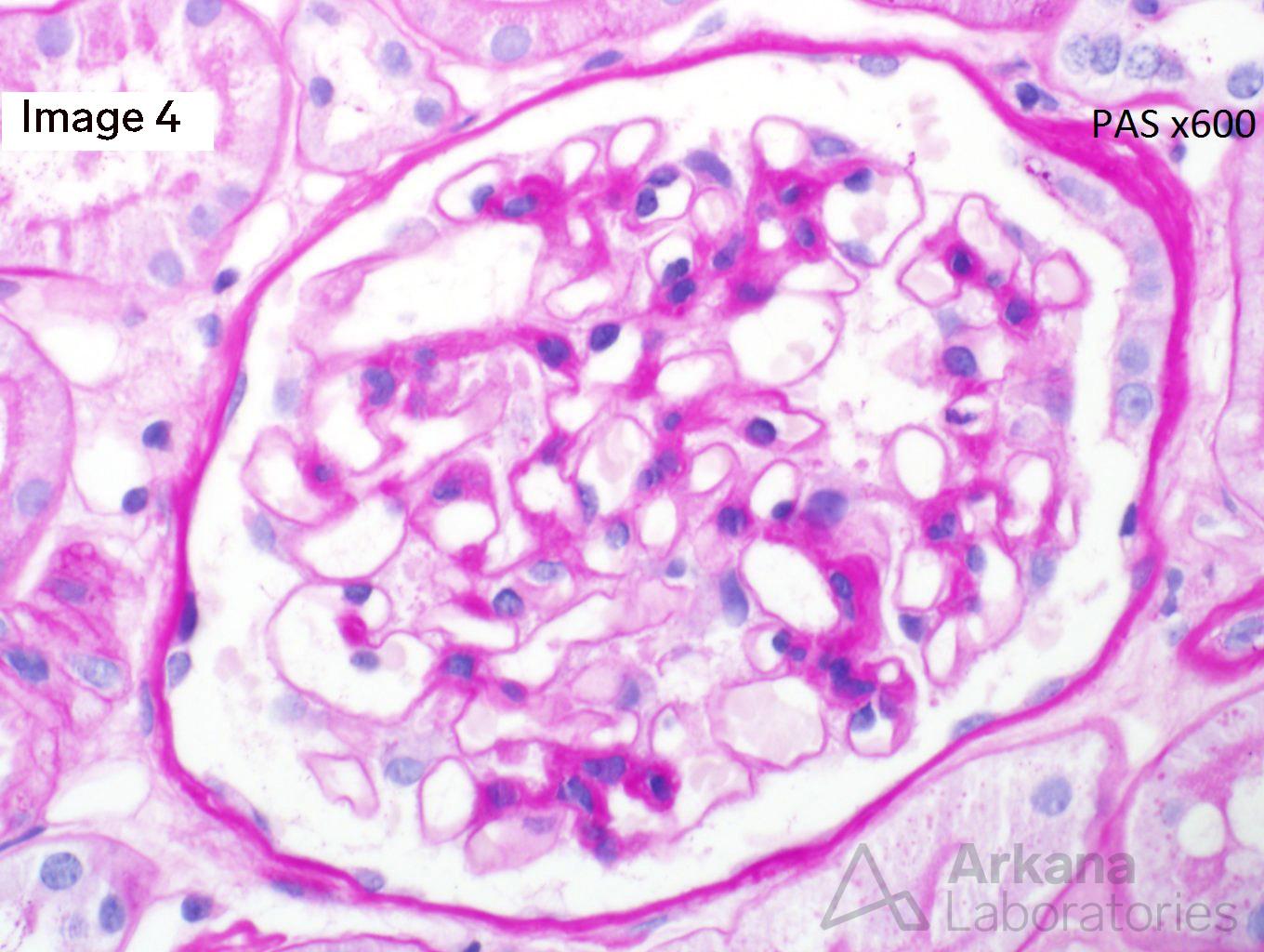 ALECT2 Amyloidosis