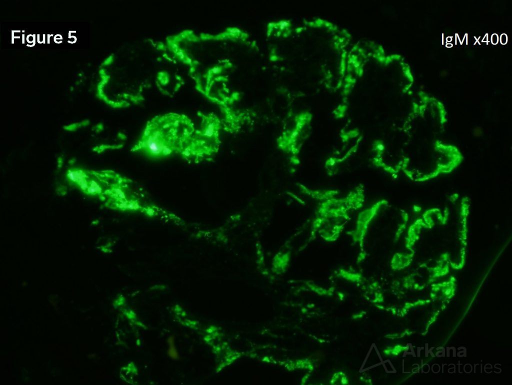 IgM, renal biopsy, kidney pathology