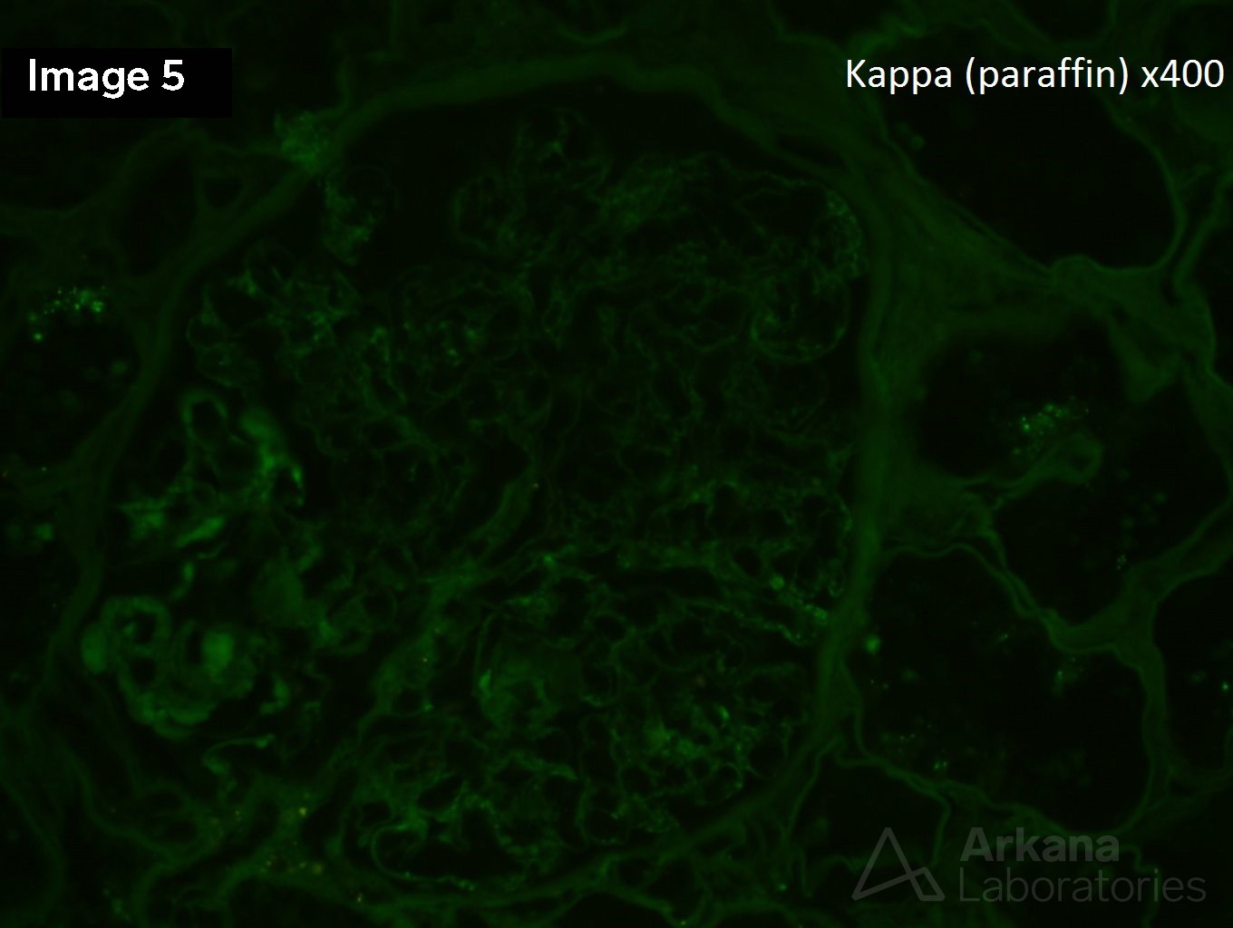 Type 1 Cryoglobulinemic Glomerulonephritis