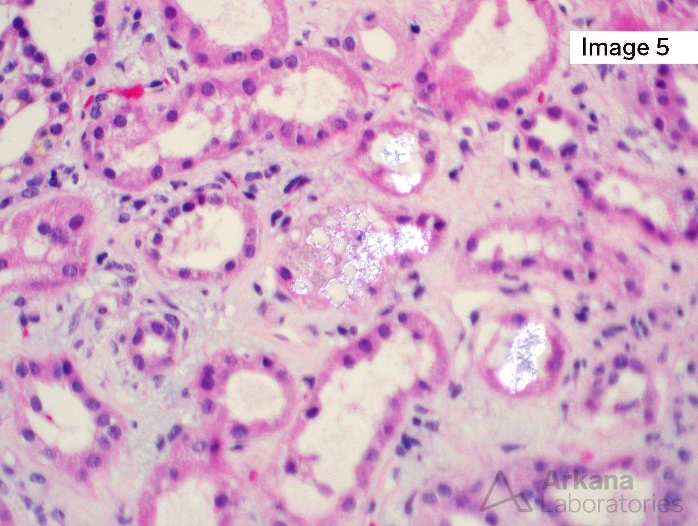 Methotrexate-Induced Crystal Nephropathy