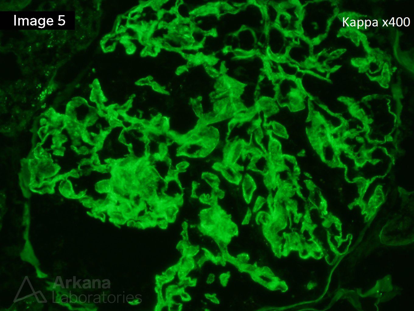 Membranous Nephropathy