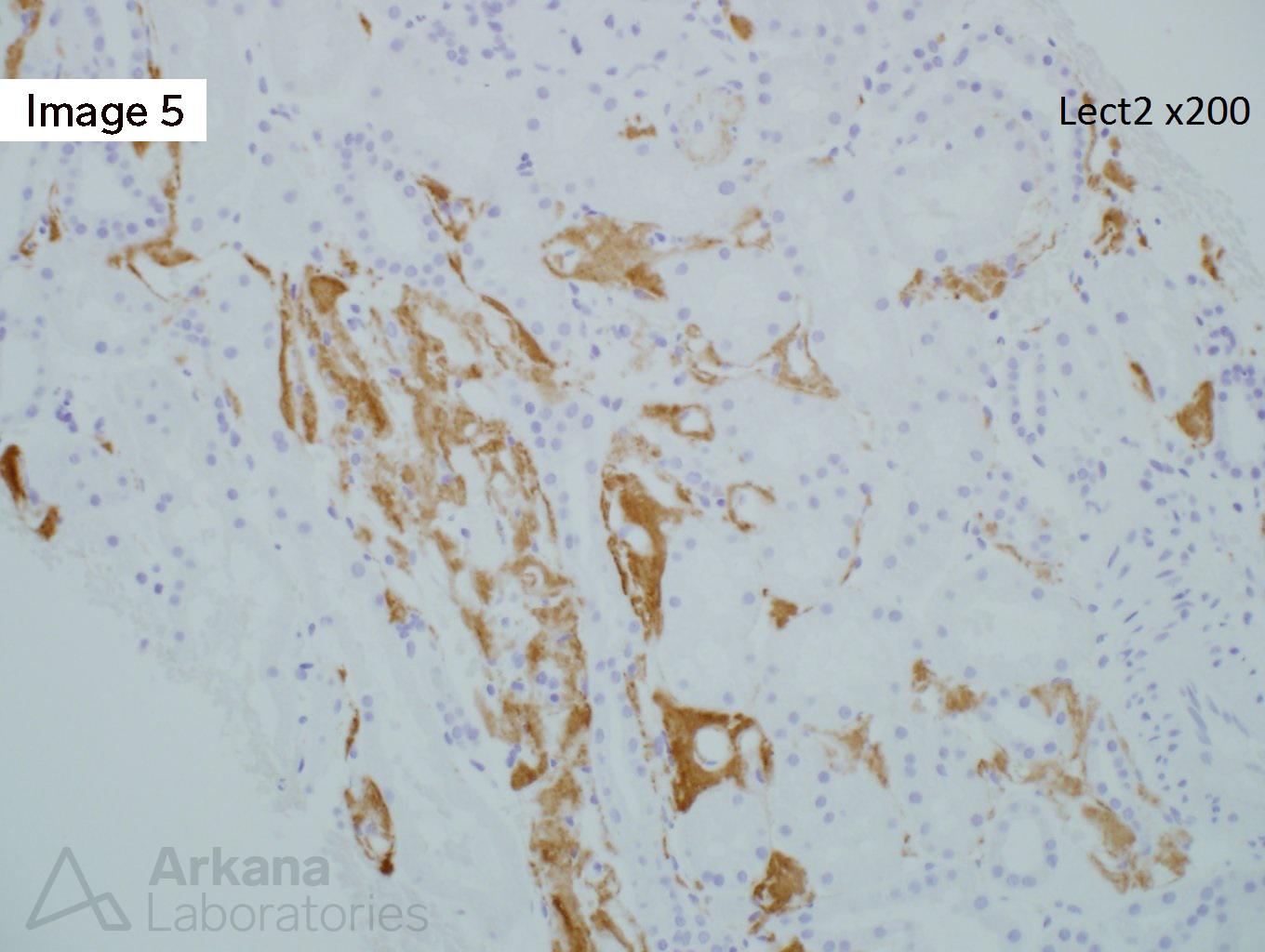 ALECT2 Amyloidosis