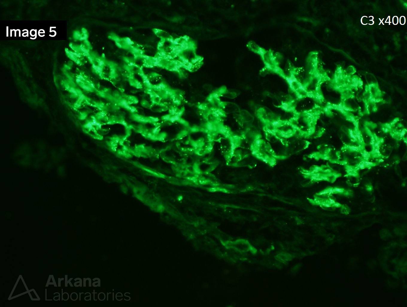 Endocarditis-Associated Glomerulonephritis