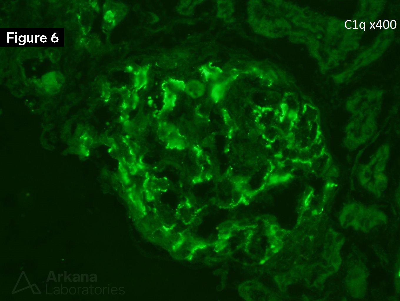 Membranous Lupus Nephritis